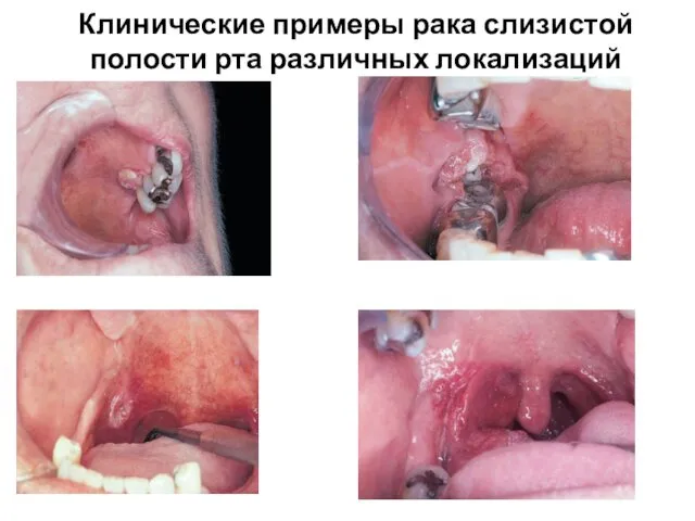 Клинические примеры рака слизистой полости рта различных локализаций