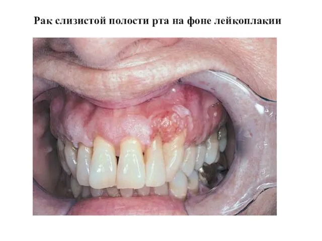 Рак слизистой полости рта на фоне лейкоплакии