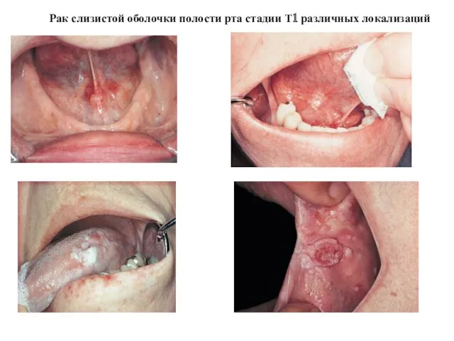 Рак слизистой оболочки полости рта стадии Т1 различных локализаций