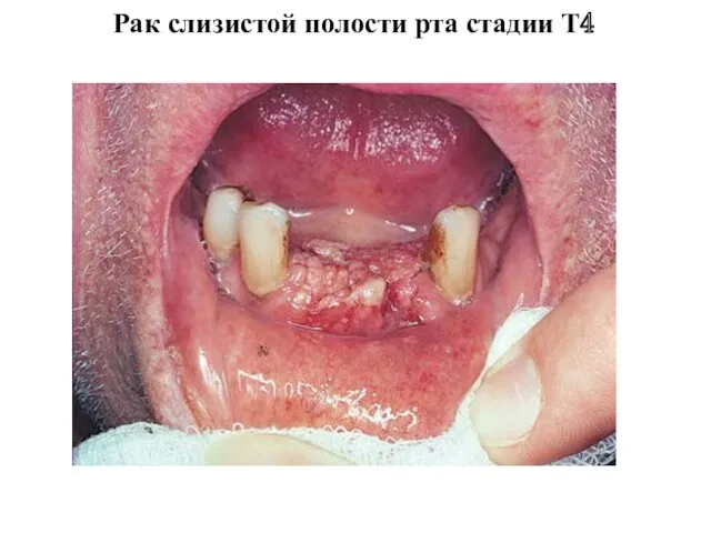 Рак слизистой полости рта стадии Т4