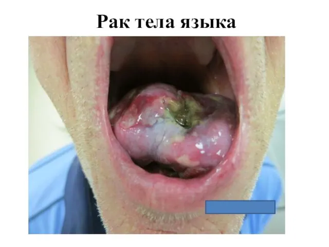 Рак тела языка