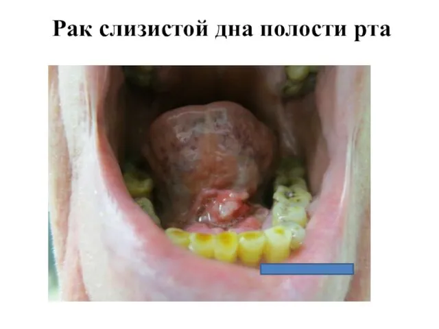 Рак слизистой дна полости рта