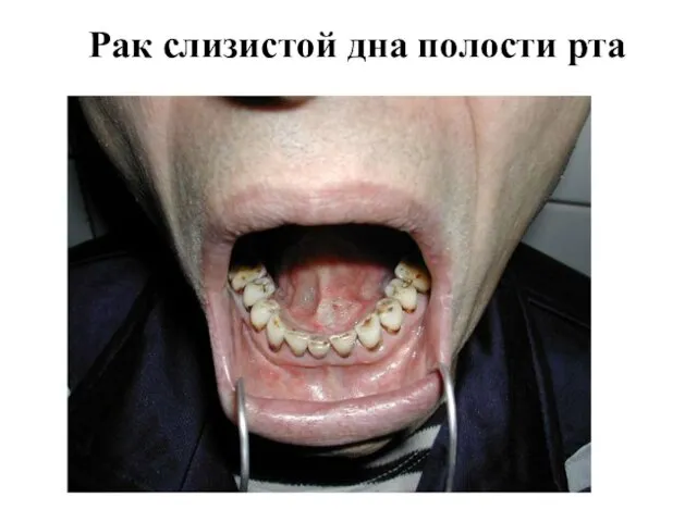 Рак слизистой дна полости рта