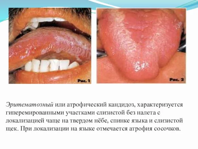 Эритематозный или атрофический кандидоз, характеризуется гиперемированными участками слизистой без налета