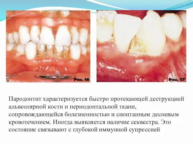 Пародонтит характеризуется быстро протекающей деструкцией альвеолярной кости и периодонтальной ткани,