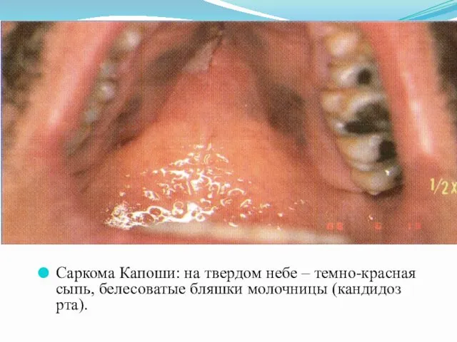 Саркома Капоши: на твердом небе – темно-красная сыпь, белесоватые бляшки молочницы (кандидоз рта).