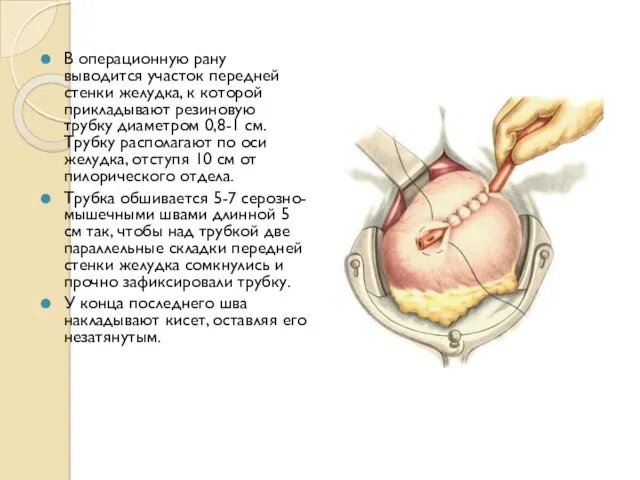 В операционную рану выводится участок передней стенки желудка, к которой