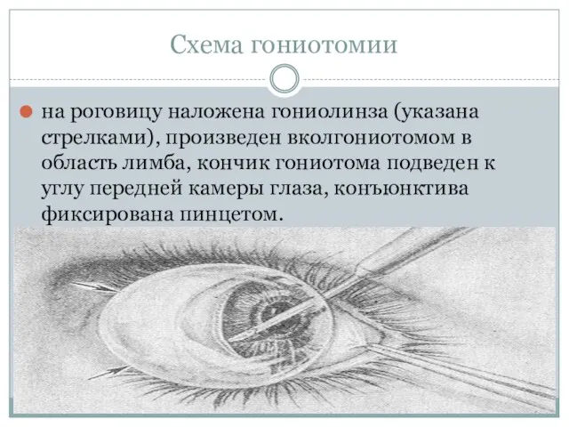 Схема гониотомии на роговицу наложена гониолинза (указана стрелками), произведен вколгониотомом