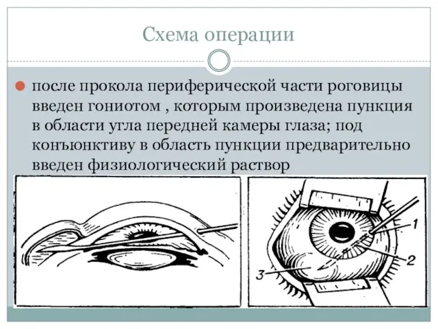 Схема операции после прокола периферической части роговицы введен гониотом ,