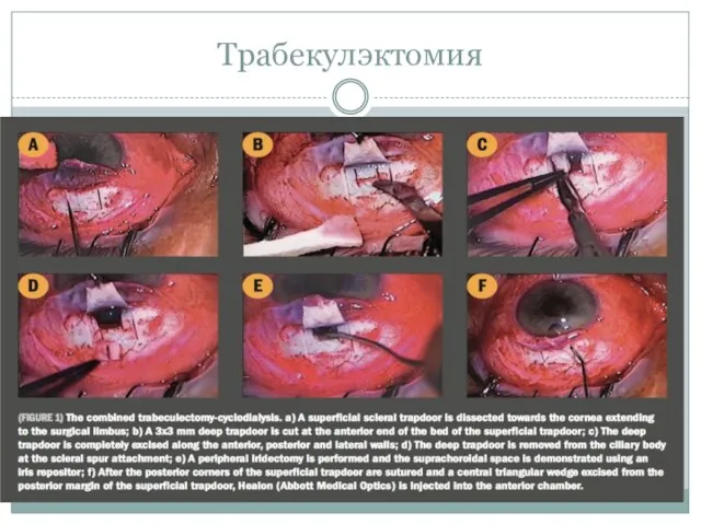 Трабекулэктомия