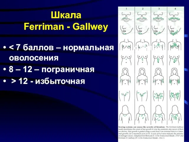 8 – 12 – пограничная > 12 - избыточная Шкала Ferriman - Gallwey