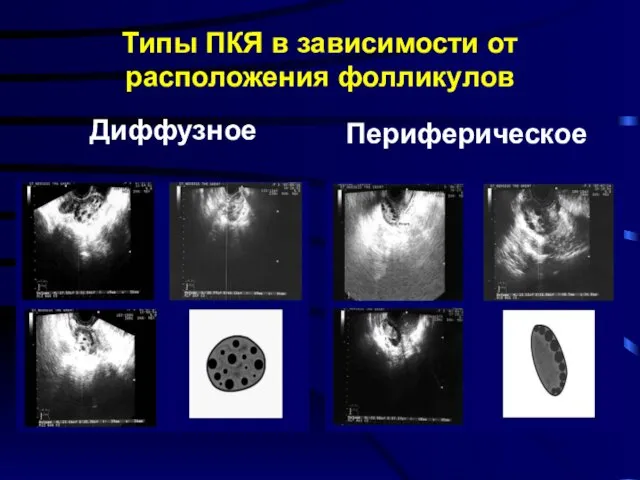 Диффузное Типы ПКЯ в зависимости от расположения фолликулов Периферическое