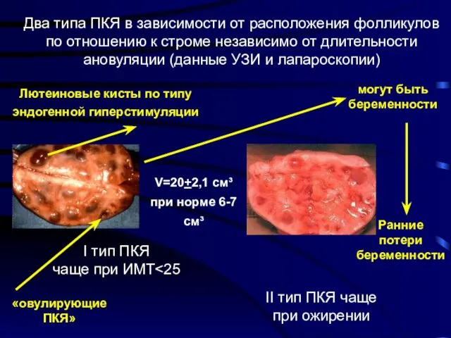 Два типа ПКЯ в зависимости от расположения фолликулов по отношению к строме независимо