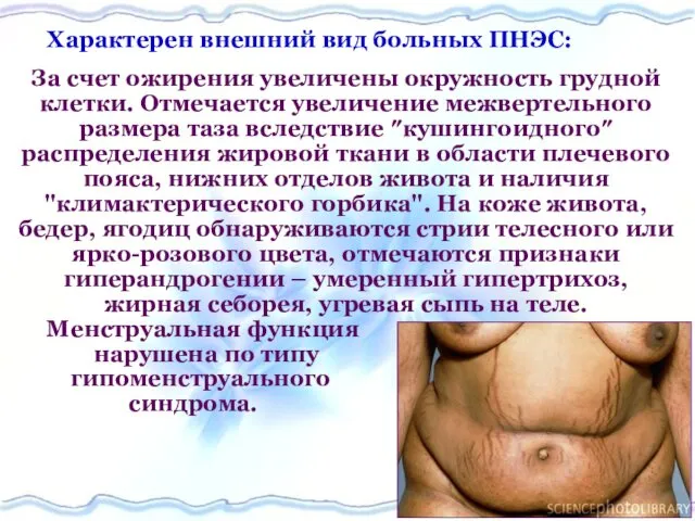 Характерен внешний вид больных ПНЭС: За счет ожирения увеличены окружность грудной клетки. Отмечается