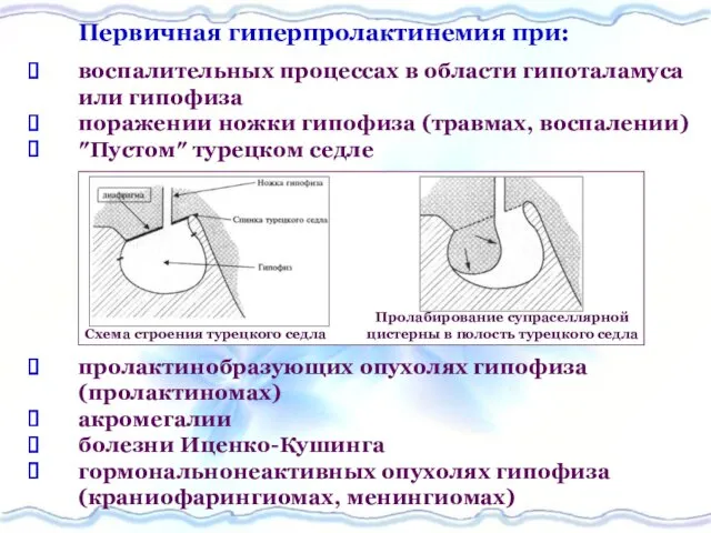 Первичная гиперпролактинемия при: воспалительных процессах в области гипоталамуса или гипофиза поражении ножки гипофиза