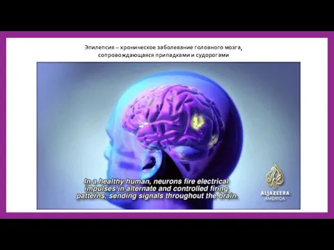 Эпилепсия – хроническое заболевание головного мозга, сопровождающаяся припадками и судорогами