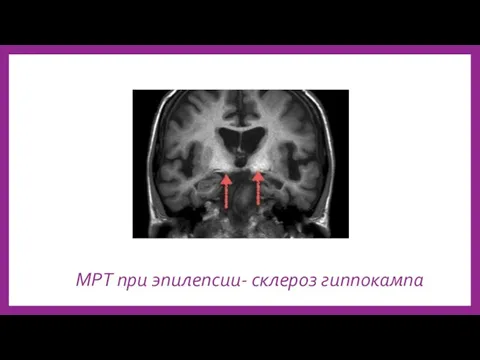 МРТ при эпилепсии- склероз гиппокампа