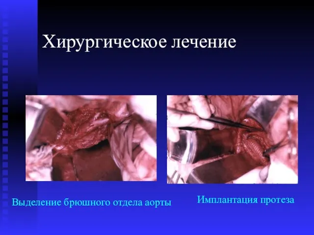 Хирургическое лечение Выделение брюшного отдела аорты Имплантация протеза
