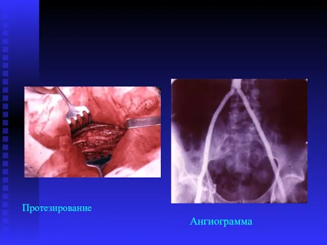 Протезирование Ангиограмма