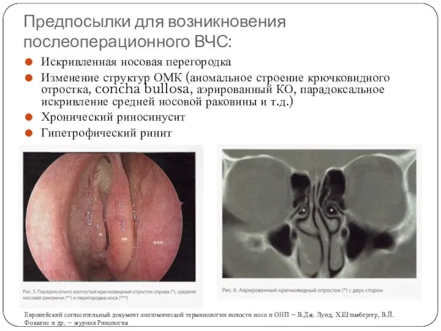 Предпосылки для возникновения послеоперационного ВЧС: Искривленная носовая перегородка Изменение структур ОМК (аномальное строение