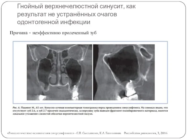 Гнойный верхнечелюстной синусит, как результат не устранённых очагов одонтогенной инфекции Причина - неэффективно пролеченный зуб