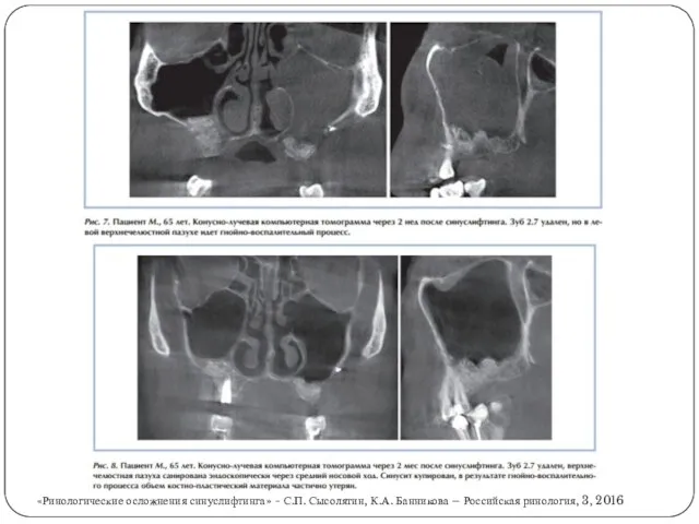 «Ринологические осложнения синуслифтинга» - С.П. Сысолятин, К.А. Банникова – Российская ринология, 3, 2016