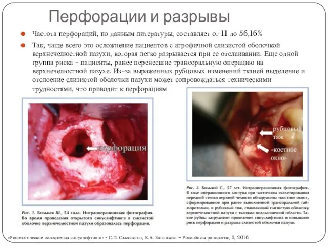 Перфорации и разрывы Частота перфораций, по данным литературы, составляет от 11 до 56,16%