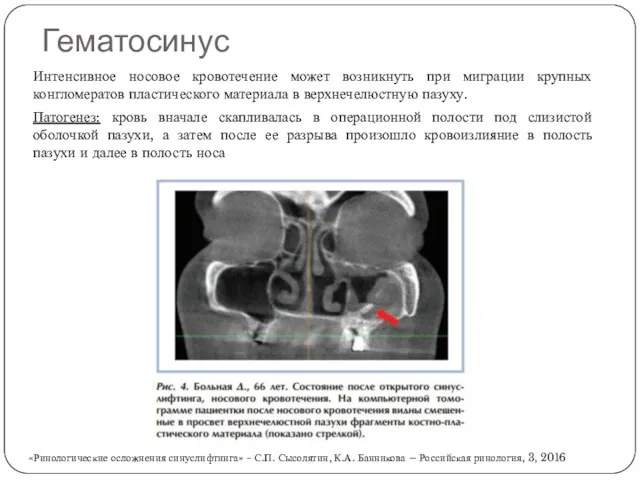 Гематосинус Интенсивное носовое кровотечение может возникнуть при миграции крупных конгломератов пластического материала в