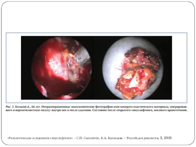 «Ринологические осложнения синуслифтинга» - С.П. Сысолятин, К.А. Банникова – Российская ринология, 3, 2016