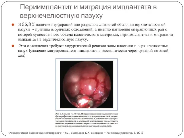 Периимплантит и миграция имплантата в верхнечелюстную пазуху В 36,3 % наличие перфораций или