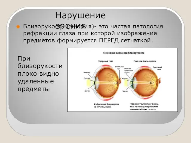 Близорукость (миопия)- это частая патология рефракции глаза при которой изображение предметов формируется ПЕРЕД