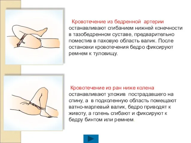Кровотечение из бедренной артерии останавливают сгибанием нижней конечности в тазобедренном