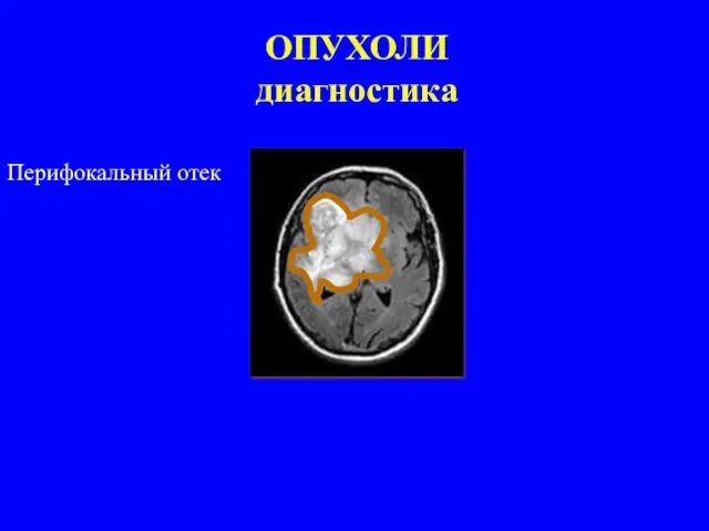 ОПУХОЛИ диагностика Перифокальный отек