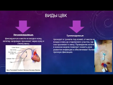 ВИДЫ ЦВК Туннелируемые- проходят в туннеле под кожей, от места их входа в