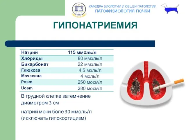 ГИПОНАТРИЕМИЯ В грудной клетке затемнение диаметром 3 см натрий мочи боле 30 ммоль/л (исключать гипокортицизм)