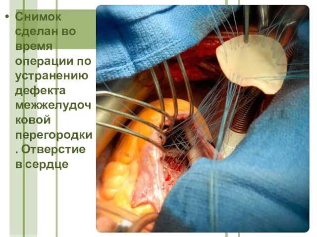 Снимок сделан во время операции по устранению дефекта межжелудочковой перегородки. Отверстие в сердце