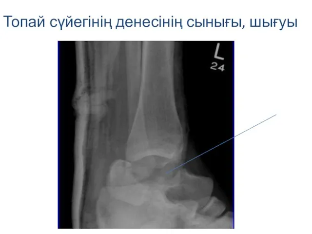 Топай сүйегінің денесінің сынығы, шығуы