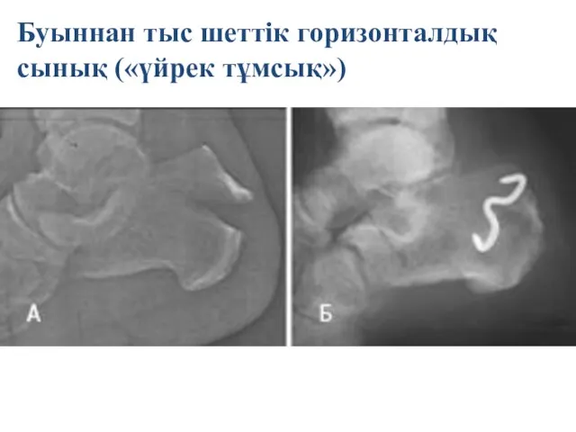 Буыннан тыс шеттік горизонталдық сынық («үйрек тұмсық»)