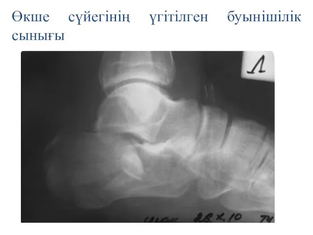 Өкше сүйегінің үгітілген буынішілік сынығы