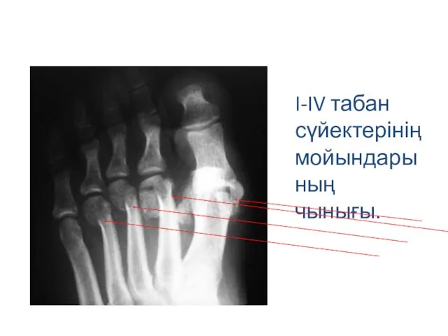 I-IV табан сүйектерінің мойындарының чынығы.