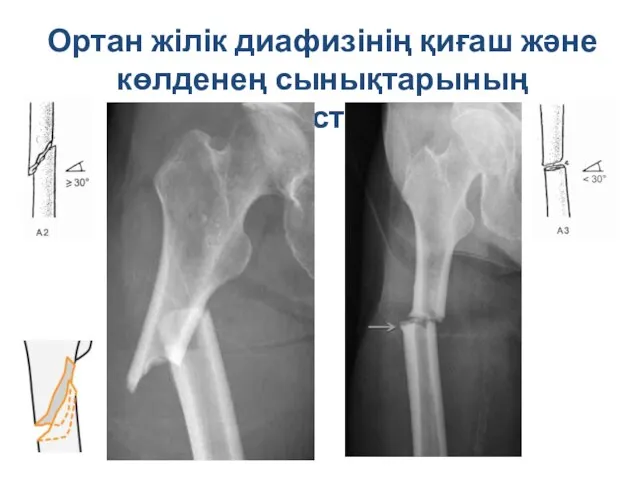 Ортан жілік диафизінің қиғаш және көлденең сынықтарының диагностикасы