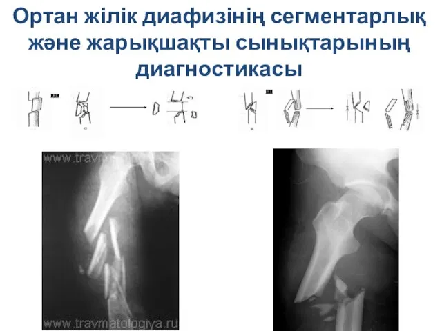 Ортан жілік диафизінің сегментарлық және жарықшақты сынықтарының диагностикасы