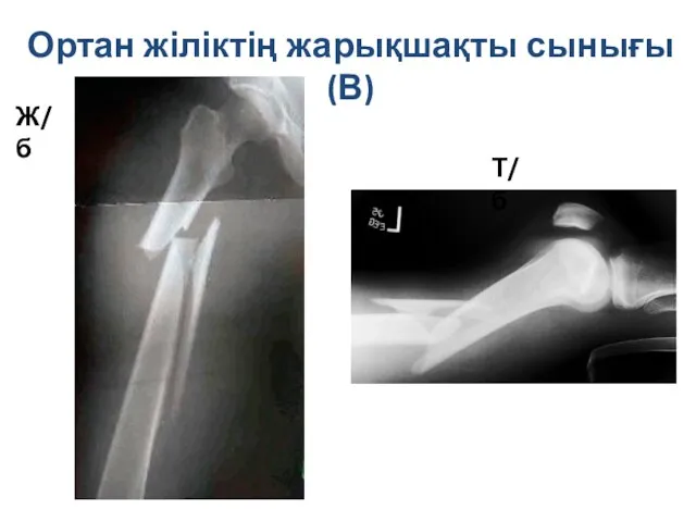 Ортан жіліктің жарықшақты сынығы (В) Ж/б Т/б