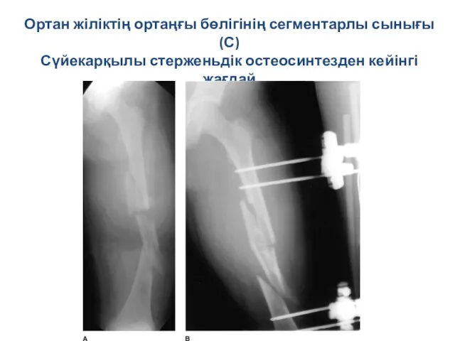 Ортан жіліктің ортаңғы бөлігінің сегментарлы сынығы (С) Сүйекарқылы стерженьдік остеосинтезден кейінгі жағдай остеосинтеза