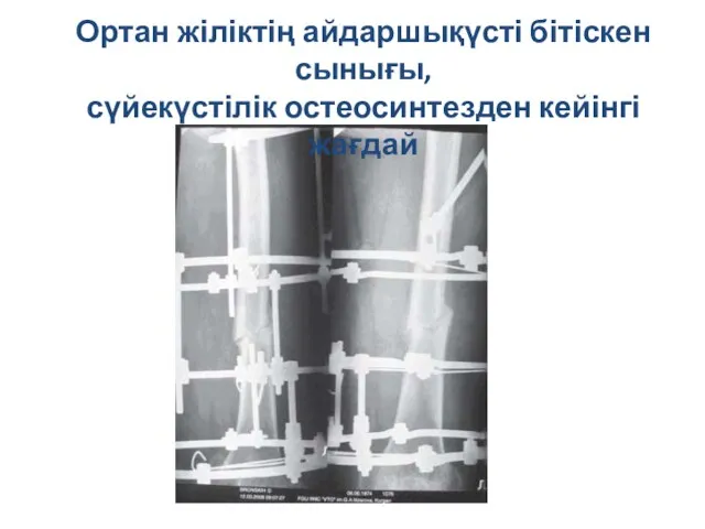 Ортан жіліктің айдаршықүсті бітіскен сынығы, сүйекүстілік остеосинтезден кейінгі жағдай