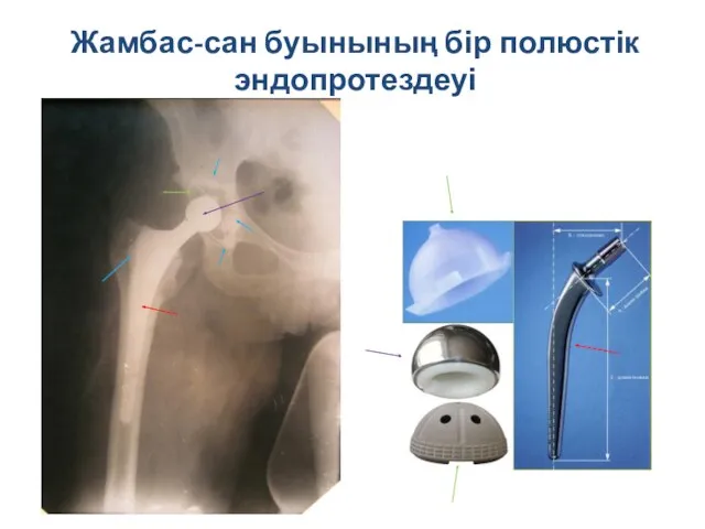 Жамбас-сан буынының бір полюстік эндопротездеуі