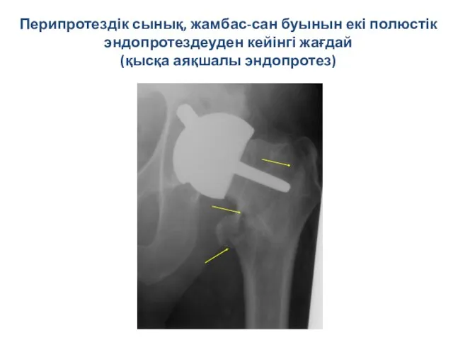 Перипротездік сынық, жамбас-сан буынын екі полюстік эндопротездеуден кейінгі жағдай (қысқа аяқшалы эндопротез)