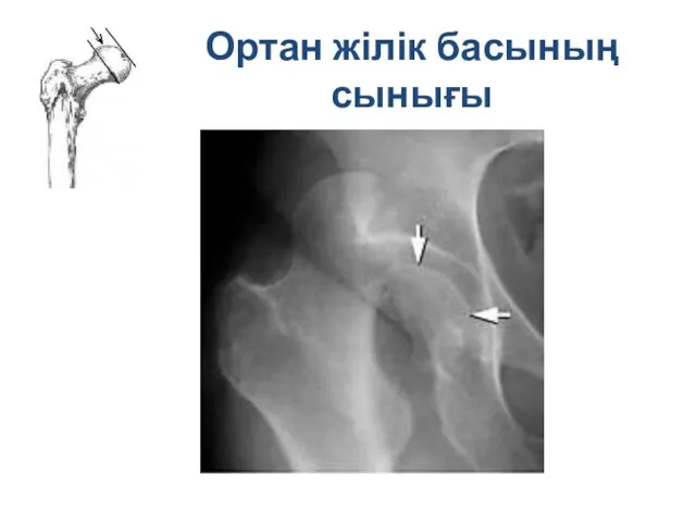 Ортан жілік басының сынығы