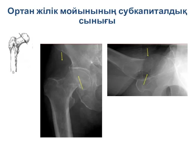 Ортан жілік мойынының субкапиталдық сынығы