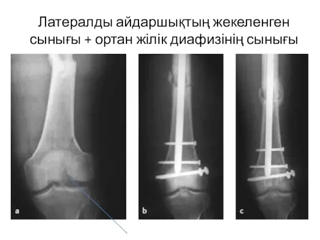 Латералды айдаршықтың жекеленген сынығы + ортан жілік диафизінің сынығы